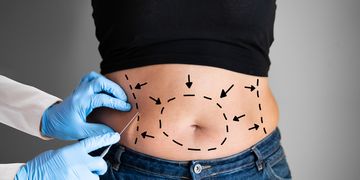 Jak dbać o bliznę po abdominoplastyce? Jak dbać o bliznę po abdominoplastyce?