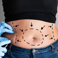 Jak dbać o bliznę po abdominoplastyce?