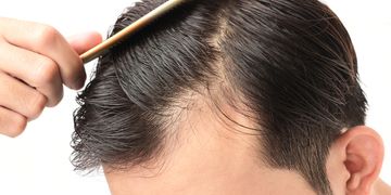 Przeszczep włosów robotyczny czy FUE manualne – która metoda jest lepsza?