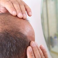 Przeszczep włosów Artas™ – co warto wiedzieć?