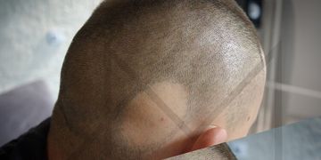 Mikropigmentacja w walce z łysieniem