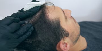 Mikropigmentacja skóry głowy a trikopigmentacja