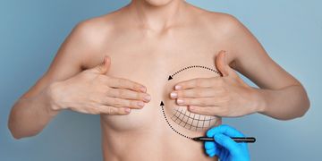 Wymiana implantów piersi – kiedy, jak i dlaczego Wymiana implantów piersi – kiedy, jak i dlaczego