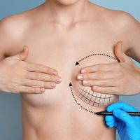 Wymiana implantów piersi – kiedy, jak i dlaczego