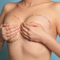 Lifting piersi - metoda minimalizująca blizny na piersi po operacji ich uniesienia