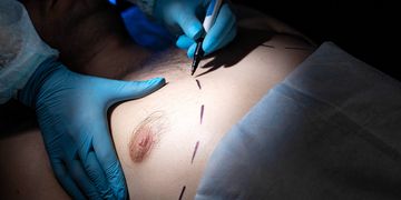 Ginekomastia – objawy, diagnostyka i leczenia Ginekomastia – objawy, diagnostyka i leczenia