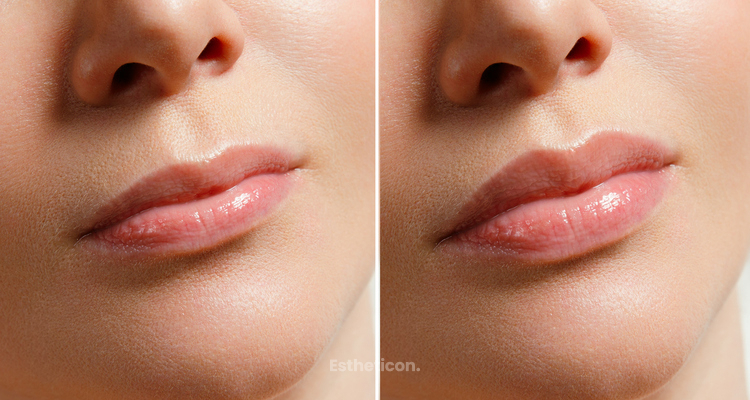 Alternatywa dla kwasu hialuronowego – powiększanie ust własną tkanką tłuszczową
