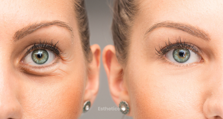 Różnice między blefaroplastyką, laserową blefaroplastyką i niechirurgiczną blefaroplastyką