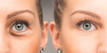 Różnice między blefaroplastyką, laserową blefaroplastyką i niechirurgiczną blefaroplastyką