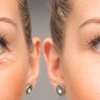 Różnice między blefaroplastyką, laserową blefaroplastyką i niechirurgiczną blefaroplastyką