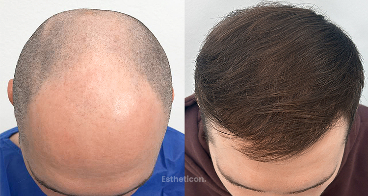 10 mitów o przeszczepie włosów, z którymi najczęściej zgłaszają się pacjenci na konsultację