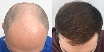 10 mitów o przeszczepie włosów, z którymi najczęściej zgłaszają się pacjenci na konsultację