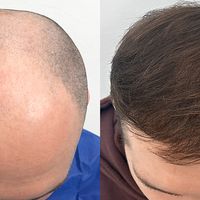 10 mitów o przeszczepie włosów, z którymi najczęściej zgłaszają się pacjenci na konsultację