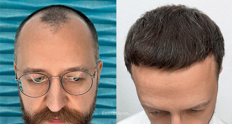 Przeszczep włosów w FullFace Clinic – standard jakości, który widać w efektach