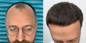 Przeszczep włosów w FullFace Clinic – standard jakości, który widać w efektach