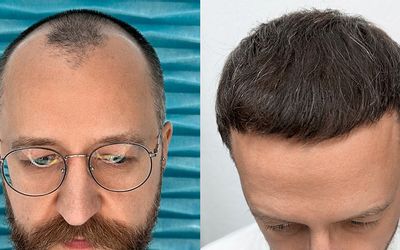 Przeszczep włosów w FullFace Clinic – standard jakości, który widać w efektach