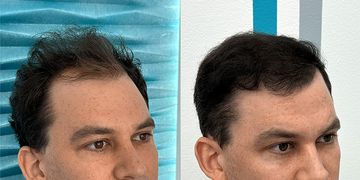 Kiedy potrzebna jest więcej niż jedna transplantacja włosów?