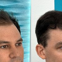 Kiedy potrzebna jest więcej niż jedna transplantacja włosów?