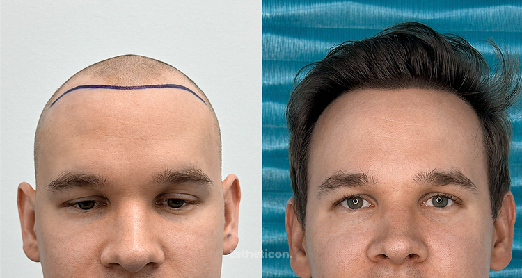 Od jakiego wieku warto rozważyć przeszczep włosów? Dlaczego granica 25 lat ma znaczenie