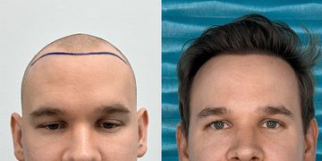 Od jakiego wieku warto rozważyć przeszczep włosów? Dlaczego granica 25 lat ma znaczenie