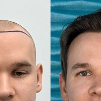 Od jakiego wieku warto rozważyć przeszczep włosów? Dlaczego granica 25 lat ma znaczenie