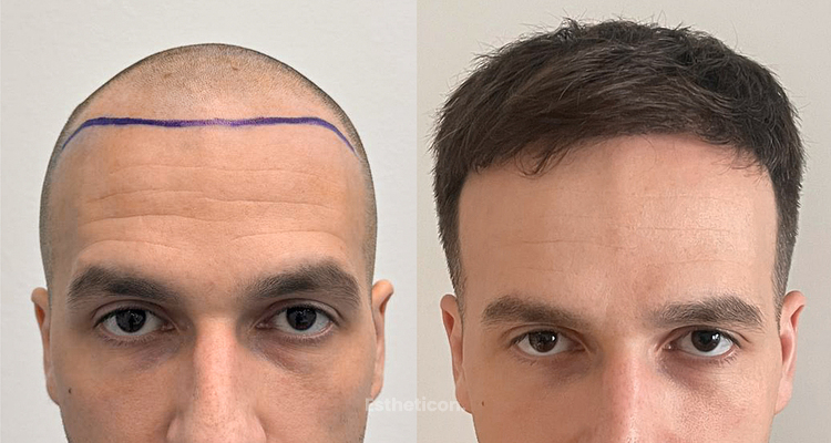 Dlaczego należy chronić strefę dawczą? Strategiczne podejście do przeszczepu włosów