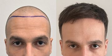 Dlaczego należy chronić strefę dawczą? Strategiczne podejście do przeszczepu włosów