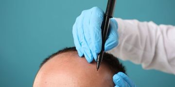 Strategiczne podejście do przeszczepu włosów - najważniejsze zasady naturalnego i trwałego efektu