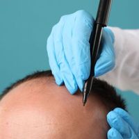 Strategiczne podejście do przeszczepu włosów - najważniejsze zasady naturalnego i trwałego efektu