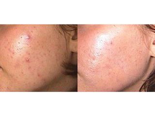 Przed i po - Leczenie trądziku