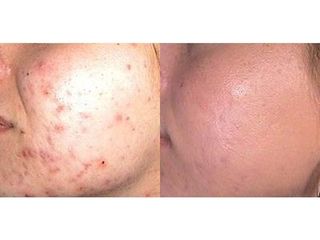 Przed i po - Leczenie trądziku