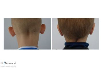 Korekta uszu - NawMedica - Klinika Chirurgii Plastycznej