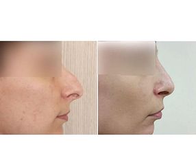 Korekta nosa - NawMedica - Klinika Chirurgii Plastycznej