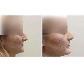 Korekta nosa - NawMedica - Klinika Chirurgii Plastycznej