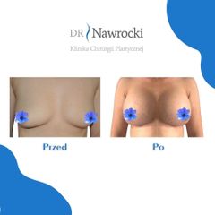Powiększanie biustu - NawMedica - Klinika Chirurgii Plastycznej