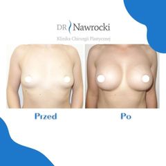 Powiększanie biustu - NawMedica - Klinika Chirurgii Plastycznej