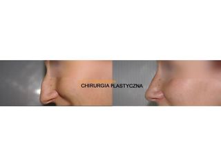 Rhinoplastyka - przed i po