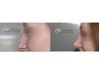 Rhinoplastyka - przed i po