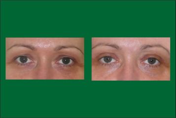 Blefaroplastyka - dr Bożena Jaklik