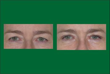 Blefaroplastyka - dr Bożena Jaklik