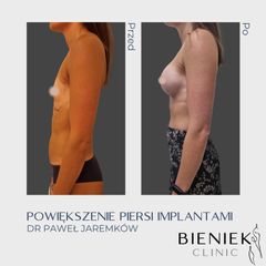 Powiększanie biustu - Dr Paweł Jaremków