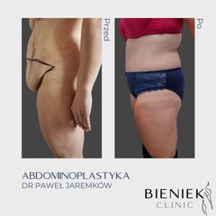Plastyka brzucha - Dr Paweł Jaremków