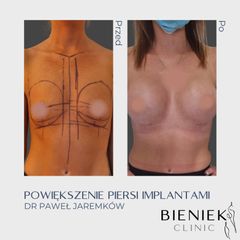 Powiększanie biustu - Dr Paweł Jaremków