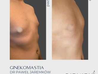 Ginekomastia przed i po - 858484