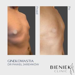Ginekomastia - Dr Paweł Jaremków