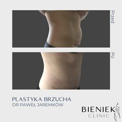 Plastyka brzucha - Dr Paweł Jaremków