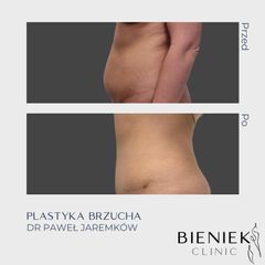 Plastyka brzucha - Dr Paweł Jaremków