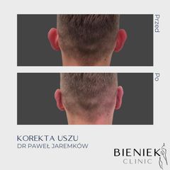 Korekcja uszu - Dr Paweł Jaremków