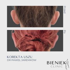 Korekcja uszu - Dr Paweł Jaremków