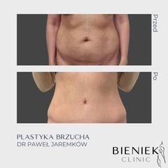 Plastyka brzucha - Dr Paweł Jaremków